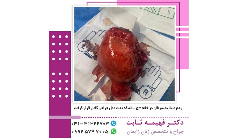 جراحی رحم مبتلا به سرطان | متخصص زنان اصفهان