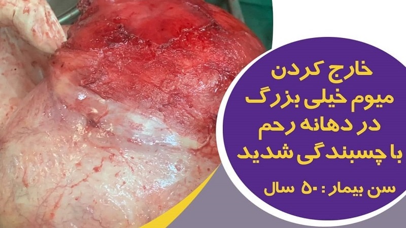 متخصص زنان اصفهان | جراحی میوم بسیار بزرگ در دهانه رحم .