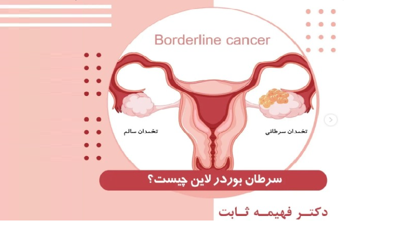 متخصص زنان اصفهان | سرطان بوردرلاین